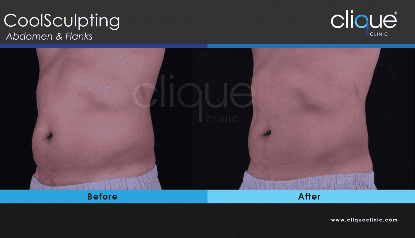 CoolSculpting Before After Photos - Clique Clinic Body