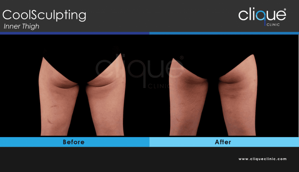 CoolSculpting Clique Clinic- Inner Thigh 1