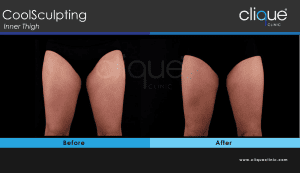 CoolSculpting before and after - Inner Thigh
