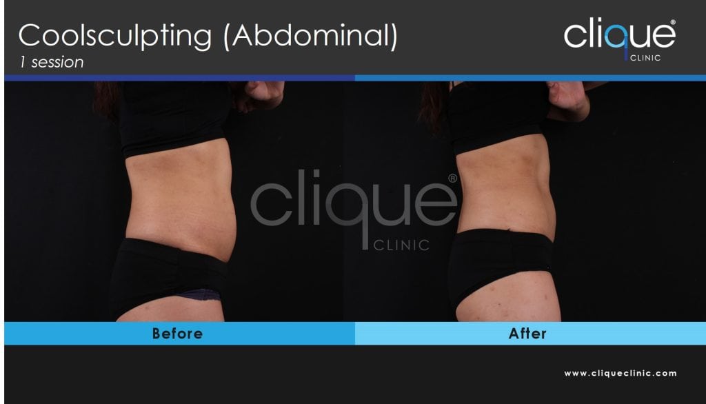 Coolsculpting Treatment in Malaysia - Coolsculpting abs ASK 1 3