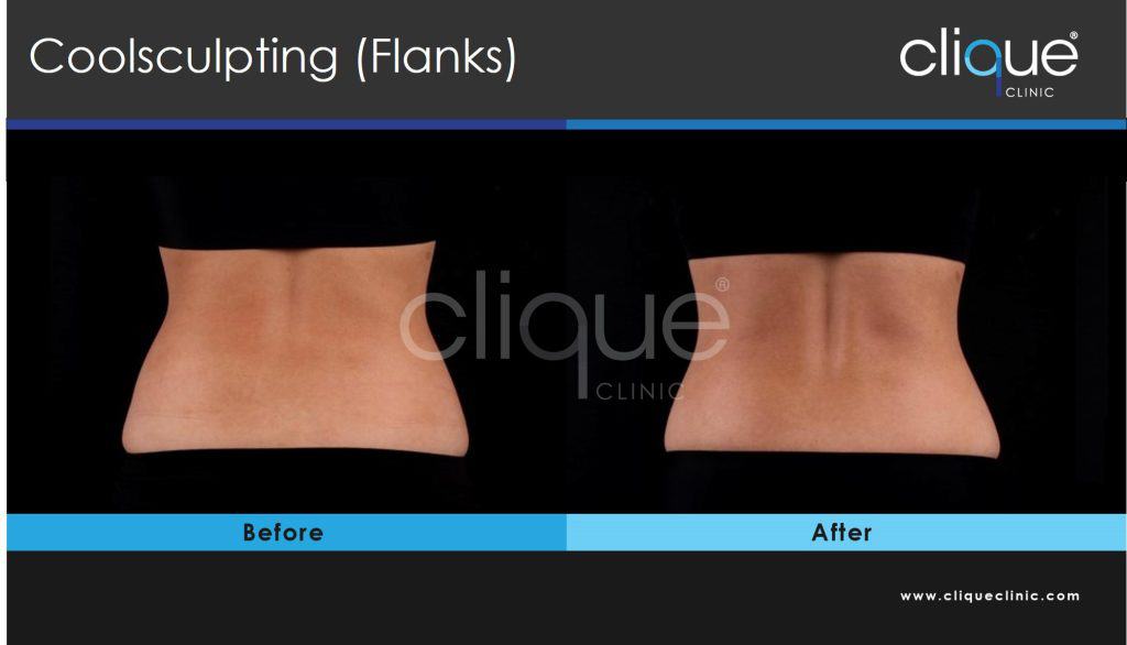 Coolsculpting fank