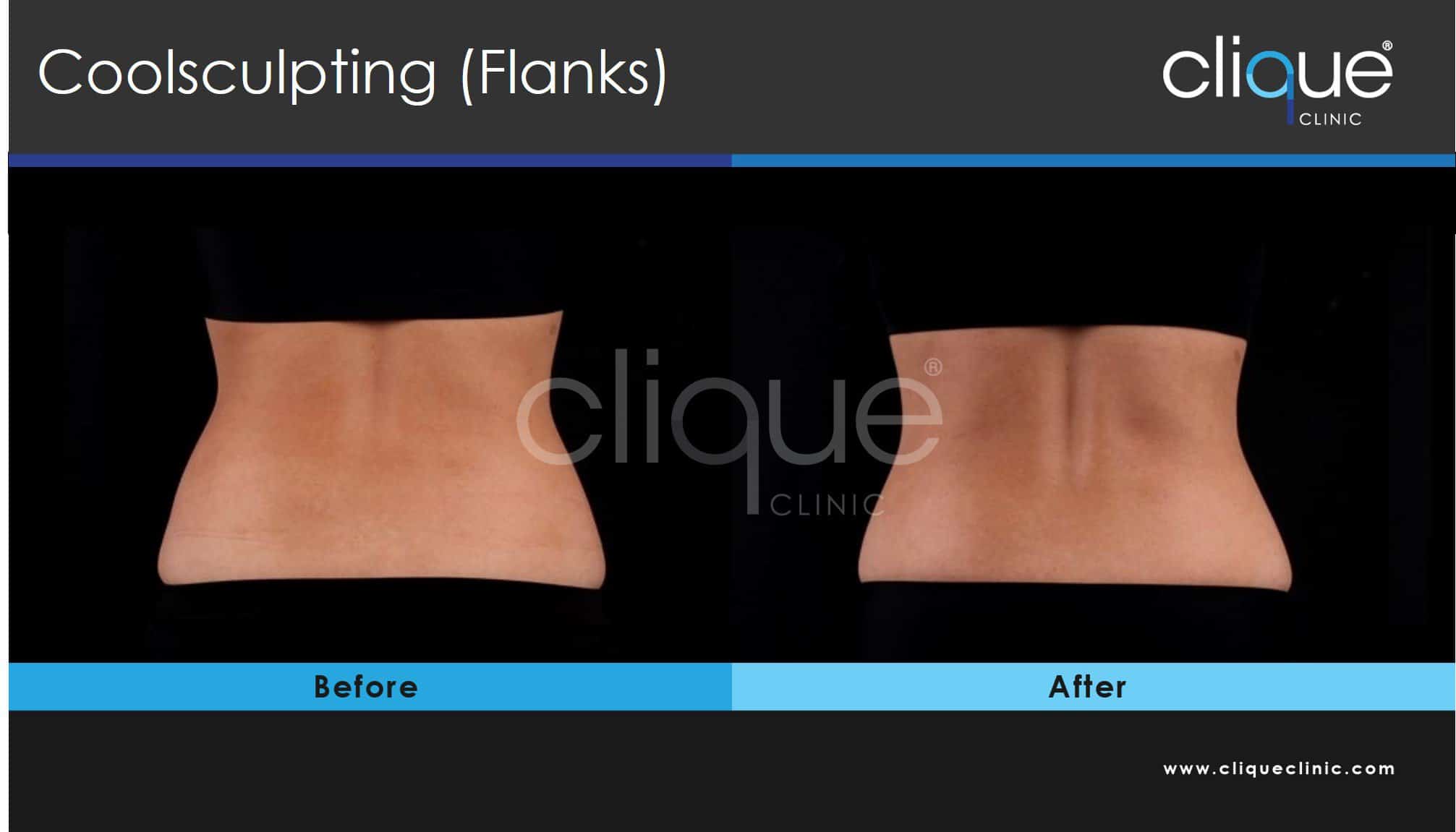 Coolsculpting fank