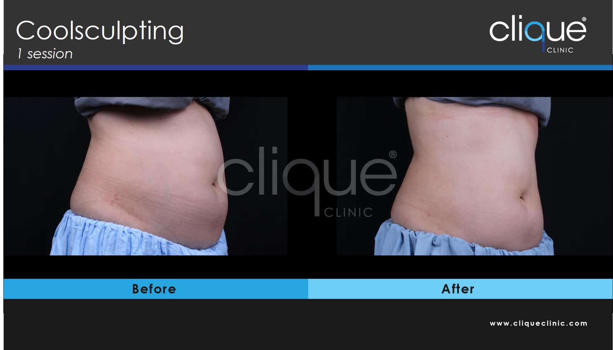 Coolsculpting flank