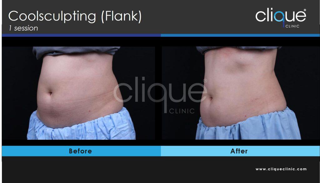 Coolsculpting flank