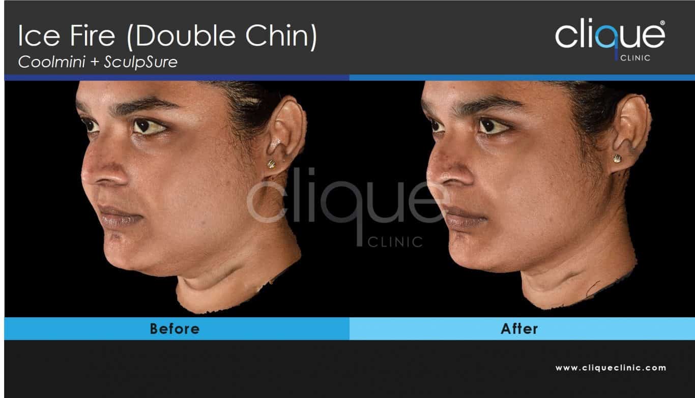 You are currently viewing CoolSculpting Before and After Photos