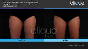 CoolSculpting Result - Outer Thigh