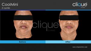 CoolSculpting Clique Clinic - Double Chin