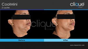 CoolSculpting Clique Clinic - Double Chin before and after