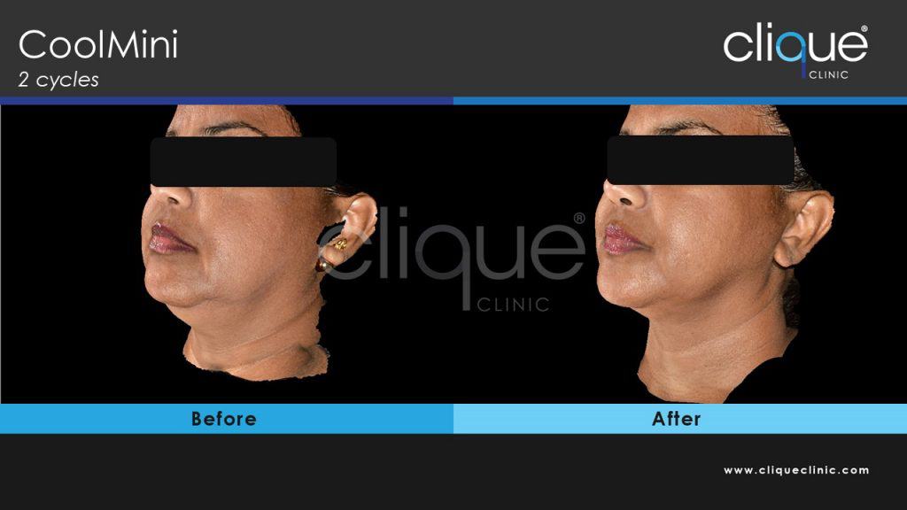 CoolSculpting Clique Clinic - Double Chin photo