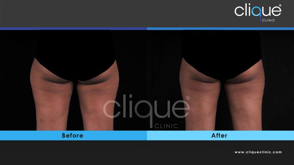 CoolSculpting Result - Outer Thigh
