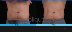 Read more about the article Combine CoolSculpting with EMSculpt NEO for Optimal Results, 2in1 plan