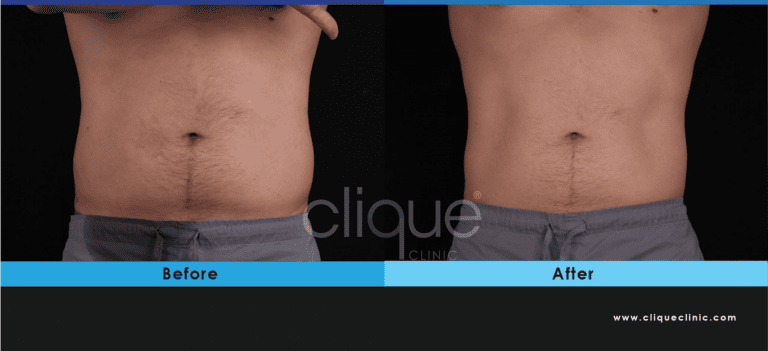 Read more about the article Combine CoolSculpting with EMSculpt NEO for Optimal Results, 2in1 plan