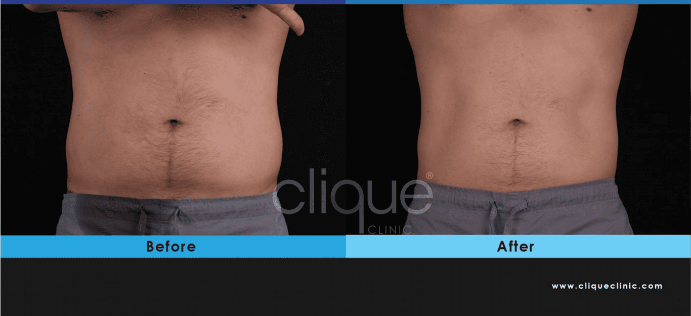 You are currently viewing Combine CoolSculpting with EMSculpt NEO for Optimal Results, 2in1 plan