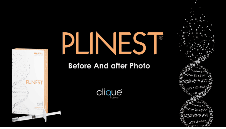Read more about the article Plinest Injection Before And After