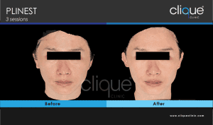 Plinest Injection Before And After - plinest before after 1 1 3