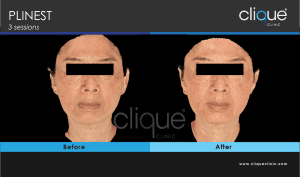 Plinest Injection Before And After - plinest before after 10 12