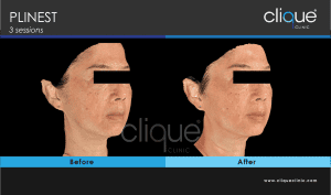 Plinest Injection Before And After - plinest before after 11 13