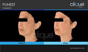Plinest Injection Before And After - plinest before after 12 11