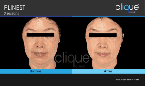 Plinest Injection Before And After - plinest before after 13 15