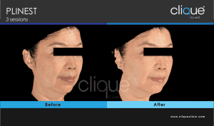 Plinest Injection Before And After - plinest before after 14 16