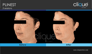 Plinest Injection Before And After - plinest before after 15 14