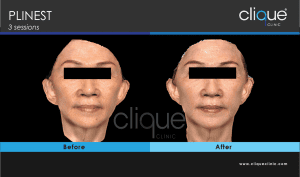 Plinest Injection Before And After - plinest before after 16 18