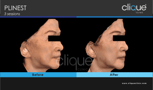 Plinest Injection Before And After - plinest before after 17 19