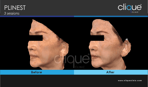Plinest Injection Before And After - plinest before after 18 17