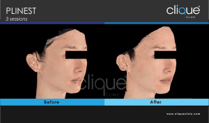 Plinest Injection Before And After - plinest before after 2 4