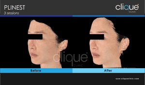 Plinest Injection Before And After - plinest before after 3 2