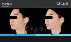 Plinest Injection method 2022 - 3 point cannula - plinest before after 38 3