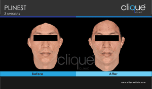 Plinest Injection Before And After - plinest before after 4 9