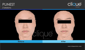 Plinest Injection method 2022 - 3 point cannula - plinest before after 40 5