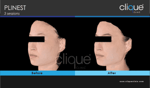 Plinest Injection method 2022 - 3 point cannula - plinest before after 41 6