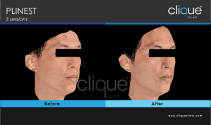 Plinest Injection Before And After - plinest before after 5 10