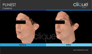 Plinest Injection Before And After - plinest before after 6 8