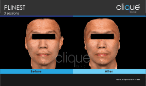 Plinest Injection Before And After - plinest before after 7 6