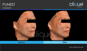 Plinest Injection Before And After - plinest before after 8 5