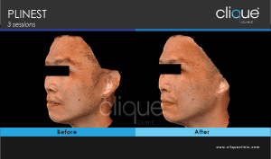 Plinest Injection Before And After - plinest before after 9 7