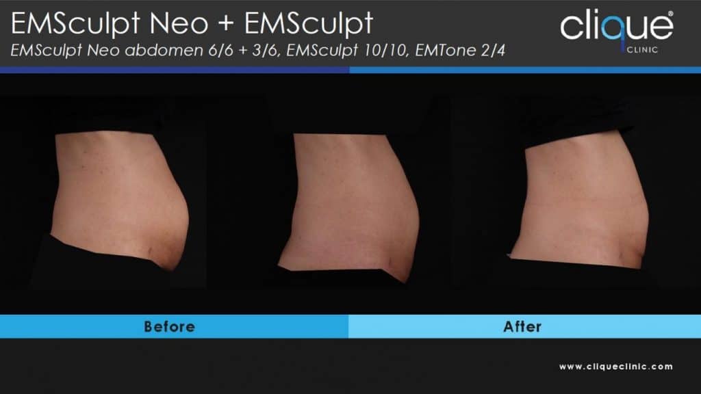 EMSculpt Neo Review - Year 2022 - EMSculpt Neo Review 2 EMSculpt Neo Review