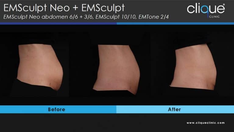Read more about the article EMSculpt Neo Review – Year 2022