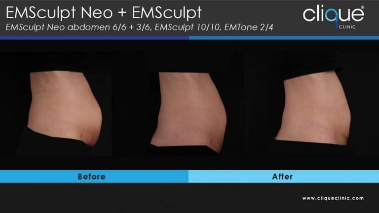 EMSculpt Neo Edge - What Body Problems Can It Fix? OR How EMSculpt