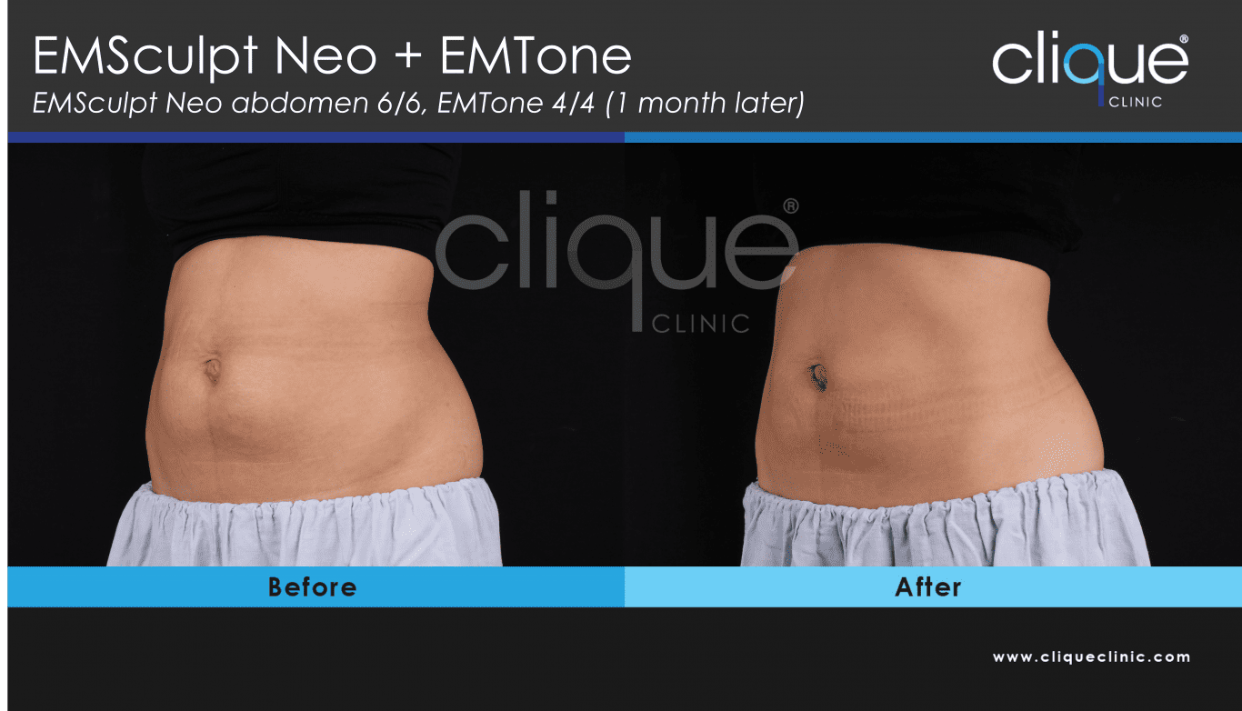 EMSculpt Neo Mommy Makeover Programme 2022 - emsculpt neo mommy makeover 16 17