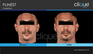 plinest before and after 46