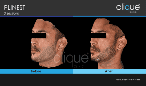 plinest before and after 47