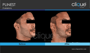 plinest before and after 48