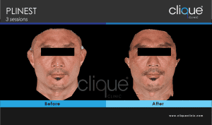 plinest before and after 49