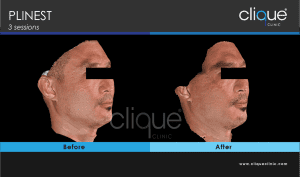 plinest before and after 51