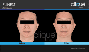plinest before and after 52