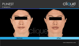 plinest before and after 55